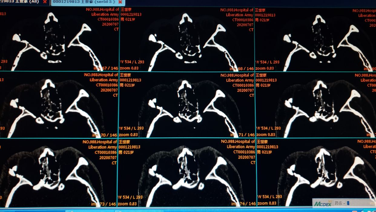 是否剪开镰状韧带,会不会引起脑脊液漏,因为有蝶骨多发骨折